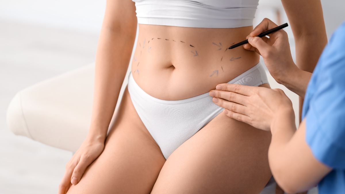 Surgeon marking a patient’s abdomen with surgical pen during a pre-operative cosmetic consultation